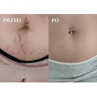 Skoncentrowany krem minimalizujący rozstępy, dla kobiet w ciąży i karmiących, EKSPERT, Cosmebio, 100 ml, Omum